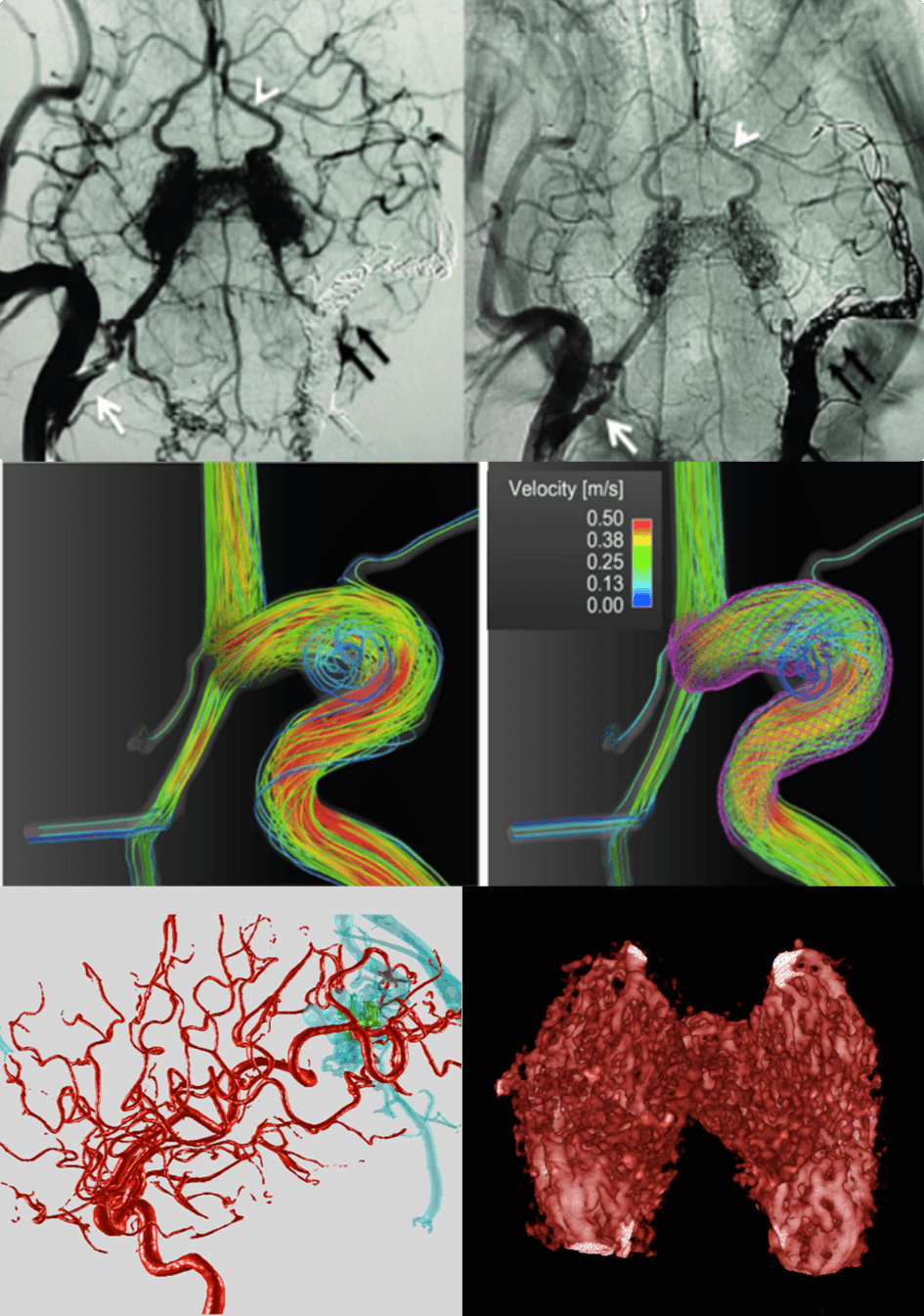 malformations vasculaires cérébrales